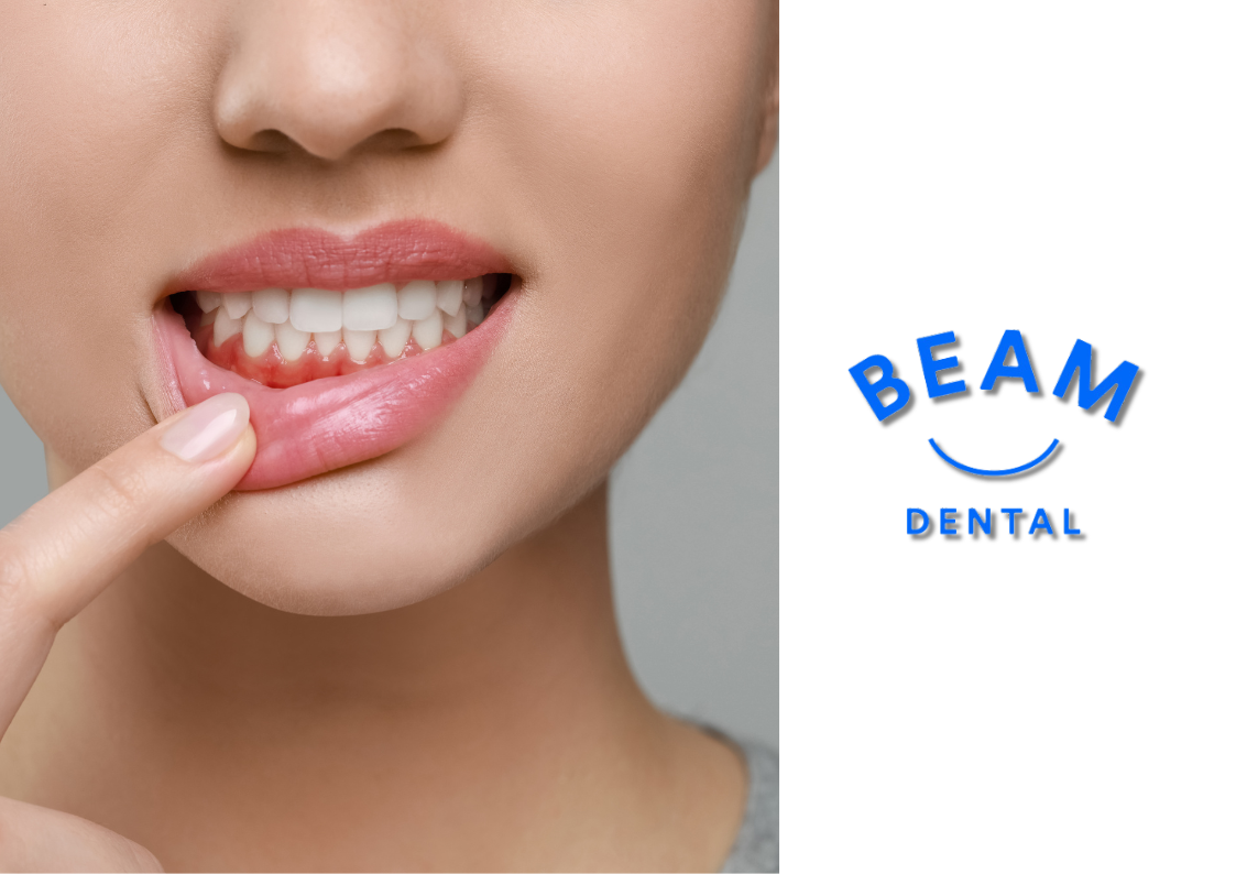 Gum Disease Treatment at Beam Dental Clinic – Expert Periodontal Care in Hendon & Brent Cross, London