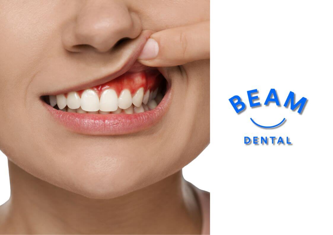 Expert Gum Treatments in North London – Beam Dental Clinic