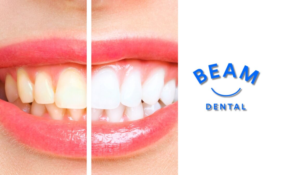 How Teeth Whitening Can Increase Confidence and Happiness