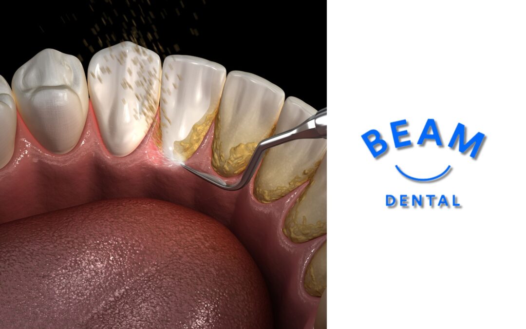 How Professional Teeth Cleaning Helps Prevent Gum Disease